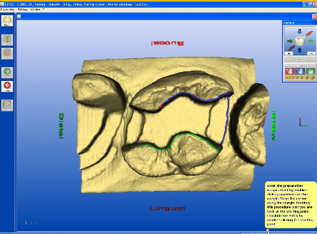 <p>What step of CAD/CAM is this?</p>