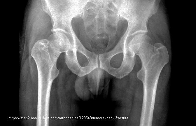<p>What is another name for a transcervical fracture?</p>
