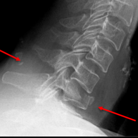 <ul><li><p>compression fracture caused by high energy axial loading - typically RTC or fall from height</p></li><li><p>Involved two or three columns - unstable</p></li><li><p>Spinal damage highly unlikely</p></li><li><p>Most involve two levels - single level injuries are unusual</p></li></ul><p></p>