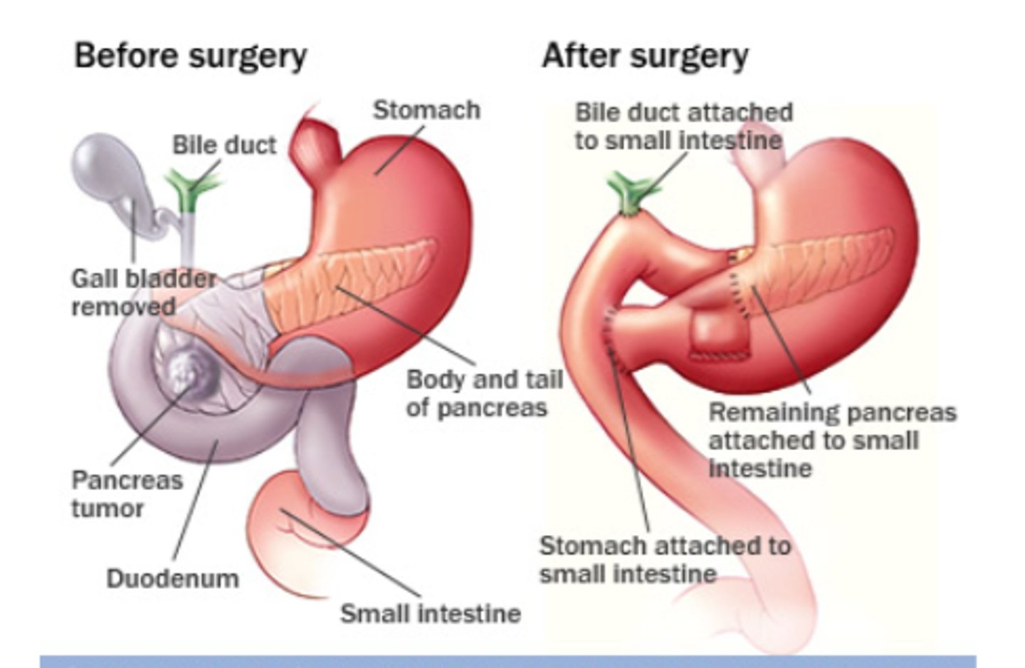 <p>Cholecystectomy</p><p>Truncal vagotomy</p><p>Antrectomy</p><p>Pancreaticoduodenectomy—removal of head of pancreas and duodenum Choledochojejunostomy—anastomosis of common bile duct to jejunum</p><p>Pancreaticojejunostomy—anastomosis of distal pancreas remnant to jejunum</p><p>Gastrojejunostomy—anastomosis of stomach to jejunum</p>