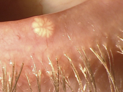 <ul><li><p>Pale, waxy, umbilicated nodules</p></li><li><p>May be single or multiple lesions</p></li><li><p>Located on the lid margin</p></li><li><p>White discharge may be expressed from the lesion (contains infected degenerate cells)</p></li><li><p>Chronic Red Eye</p></li></ul><p></p>