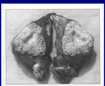 <p>Echinococcus multiocularis, alveolar hydatid cyst</p>