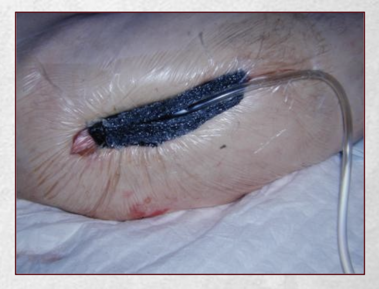 <p>-granulation tissue allowed to form in wound prior to closure</p><p class="p1">-deep narrow wounds-direct apposition over granulation tissue</p><p class="p1">-wide wounds-mobilize skin edges and advance over granulation tissue</p>