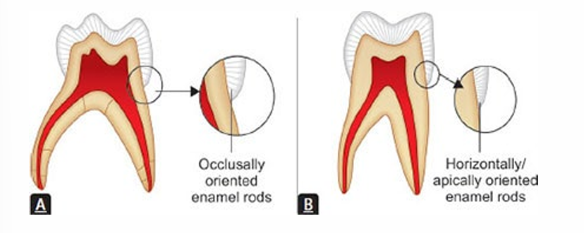 <p>-microscopically, enamel rods slope occlusally</p><p>-compared to permanent dentition where enamel rods are perpendicular or slope apically</p><p>-won’t have unsupported enamel in preps as with permanent dentition preps → less use (if any) of hand instruments</p>