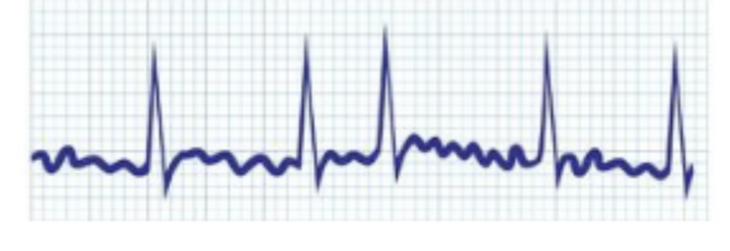 No P waves seen

CS- weakness, rapid irregular heart beat 

TX- digoxin- slow HR, No cure CHF will develop 