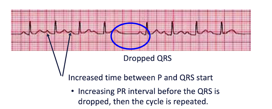 <ul><li><p>Main Characteristics:</p><ul><li><p>One or more - but not all - of the atrial impulses fail to conduct to the ventricles </p></li><li><p>Increased PR Intervals before QRS is dropped, then cycle is repeated</p></li></ul></li><li><p>2 Types:</p><ul><li><p>Type 1 // Winckebach // Mobitz Type I</p></li><li><p>Type 2 // Mobitz Type II</p></li></ul></li></ul><p></p>