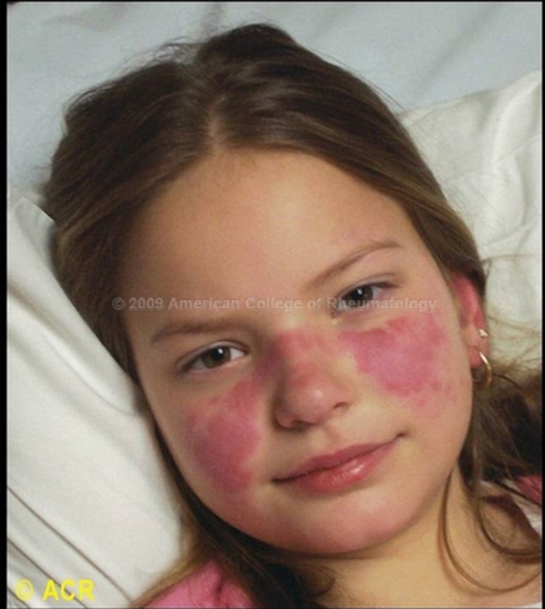 <p>Malar rash</p>