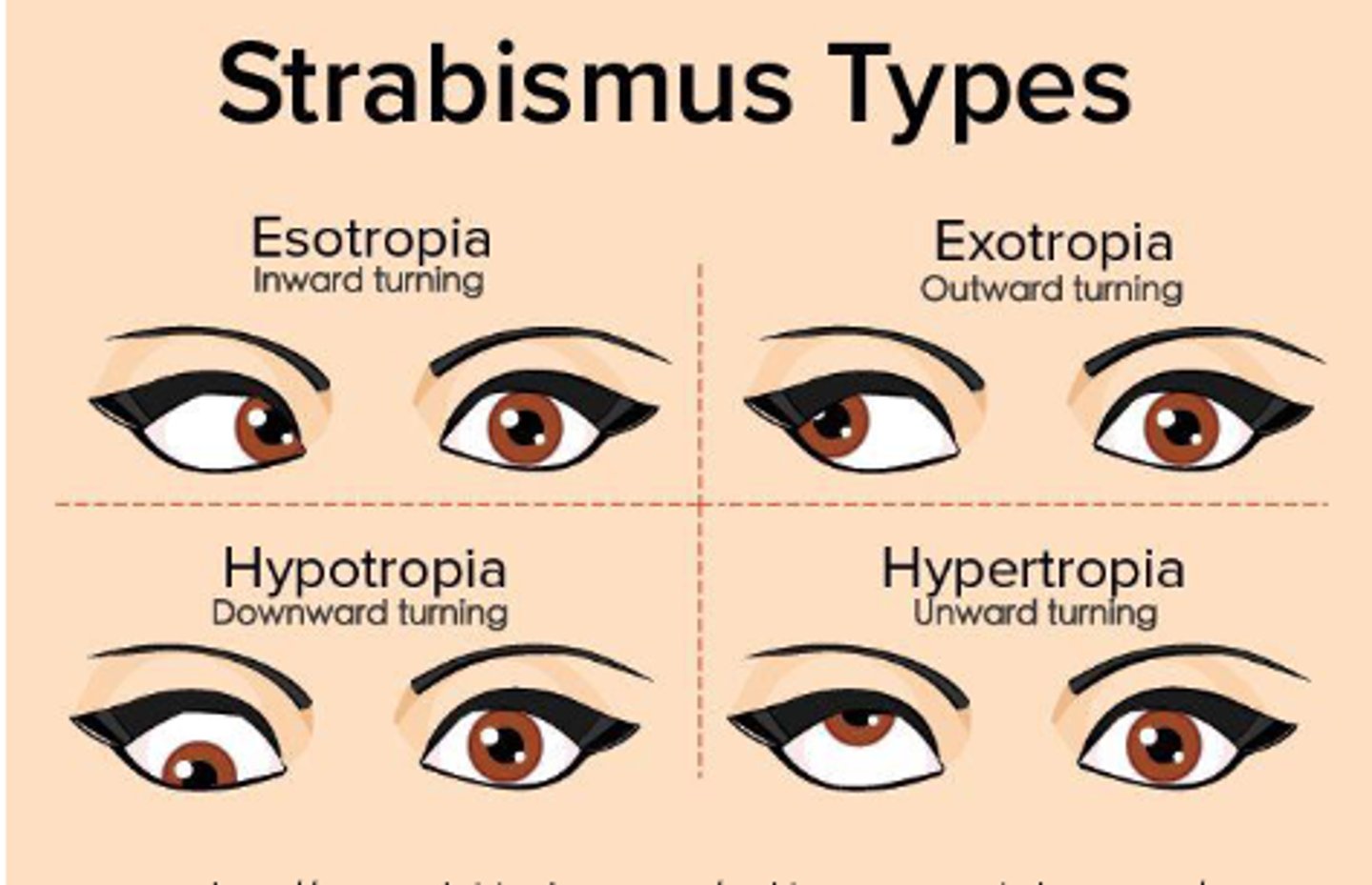 <p>- Esotropia</p><p>- Exotropia</p><p>- Hypertropia</p><p>- Hypotropia</p>