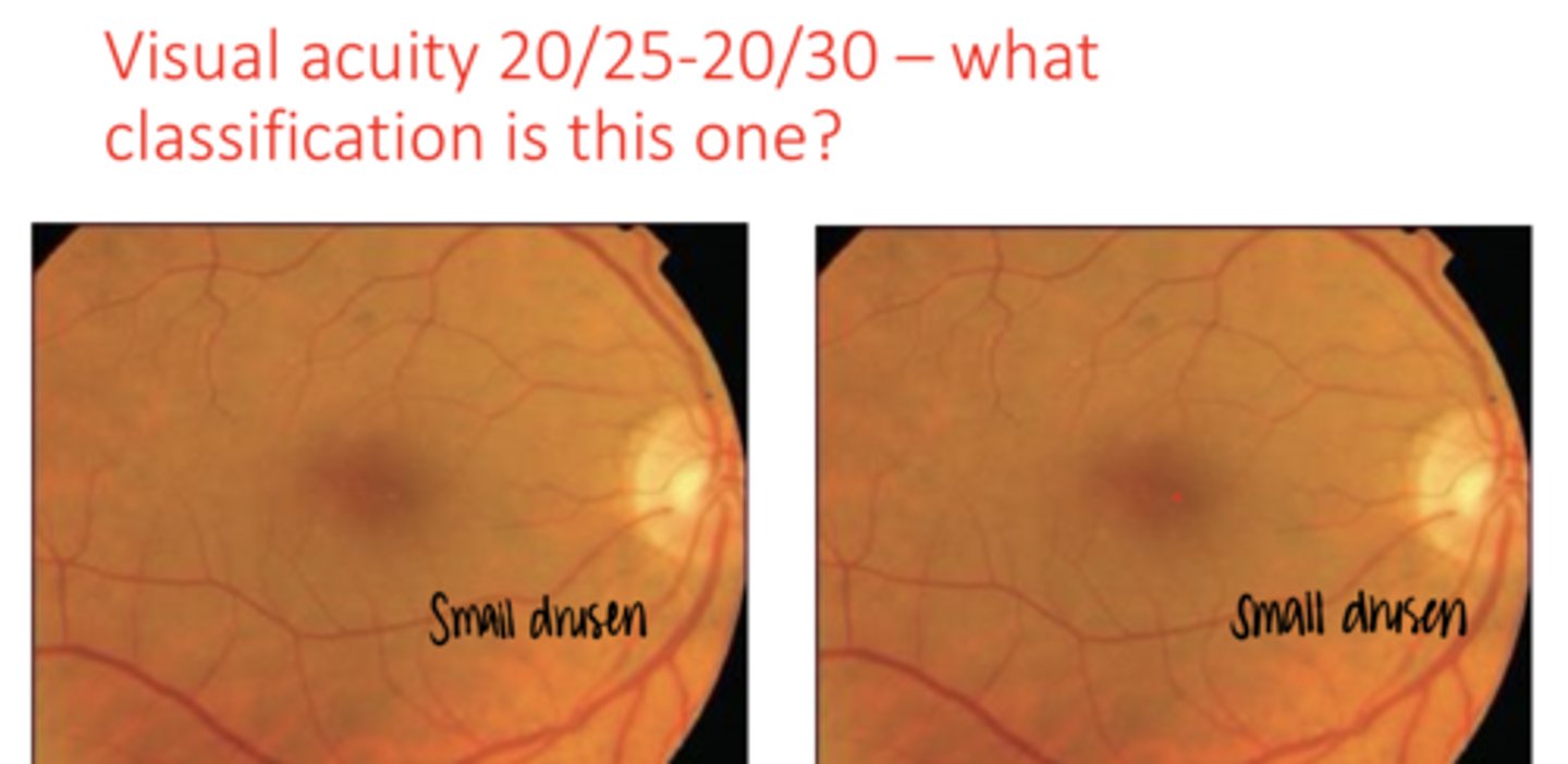 <p>What form of AMD is this pic?</p>