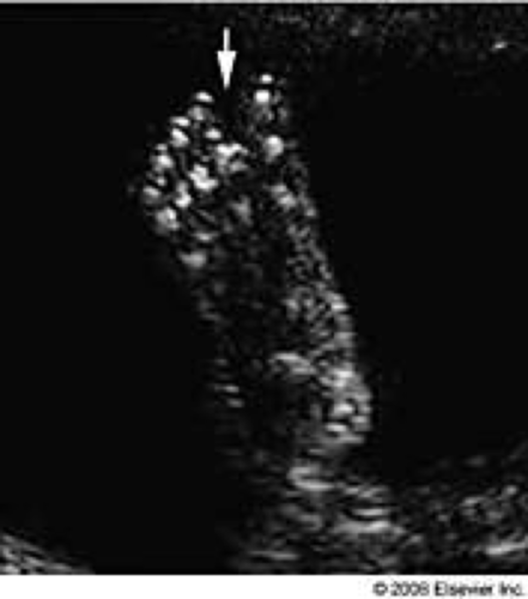 <p>Sandal toe deformity</p>