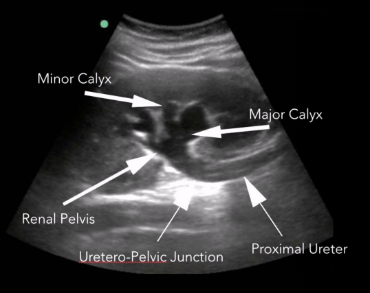 <ul><li><p>Dilation of the renal collecting system.</p></li><li><p>Includes </p><ul><li><p>Dilation of the renal pelvis (pelviectasis) </p></li><li><p>Dilation of major &amp; minor calyces (caliectasis)</p></li><li><p>Dilated proximal ureter (hydroureter)</p></li></ul></li></ul><p></p>