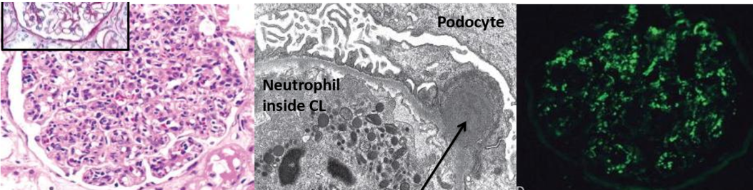 <p>Glomerulonephritis with nephritic syndrome appearing 1-4 weeks following skin/ pharyngeal infection from GAS</p><p><u>Pathogenesis</u>:</p><ol><li><p>Host immune response to pathogenic antigen causes immune complex deposition in a subendothelial location (which migrates to subepithelial)</p></li><li><p>Subsequent complement activation and inflammation causes proliferation of endothelial and mesangial cells</p><p></p></li></ol><p><u>Diagnosis</u>:</p><ul><li><p>Fever, malaise, nausea</p></li><li><p>Nephritic syndrome: oliguria, haematuria, mild proteinuria, mild-moderate HTN</p></li><li><p>Elevated tiers of anti-streptococcal Ab’s and low serum C3</p></li><li><p>Periorbital oedema</p></li><li><p>Urinalysis shows red cell casts</p></li><li><p>Biopsy shows enlarged, hypercellular glomerulus with subepithelial immune complex deposit, granular immunofluorescence</p></li></ul><p></p>