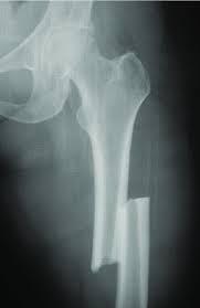 bone ends are out of normal alignment
