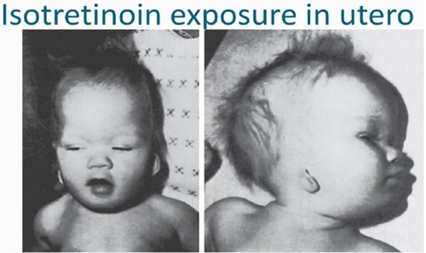 <p>Causes birth defects,</p><p>Accutane causes birth defects by shutting down mitosis, which is how babies form</p>