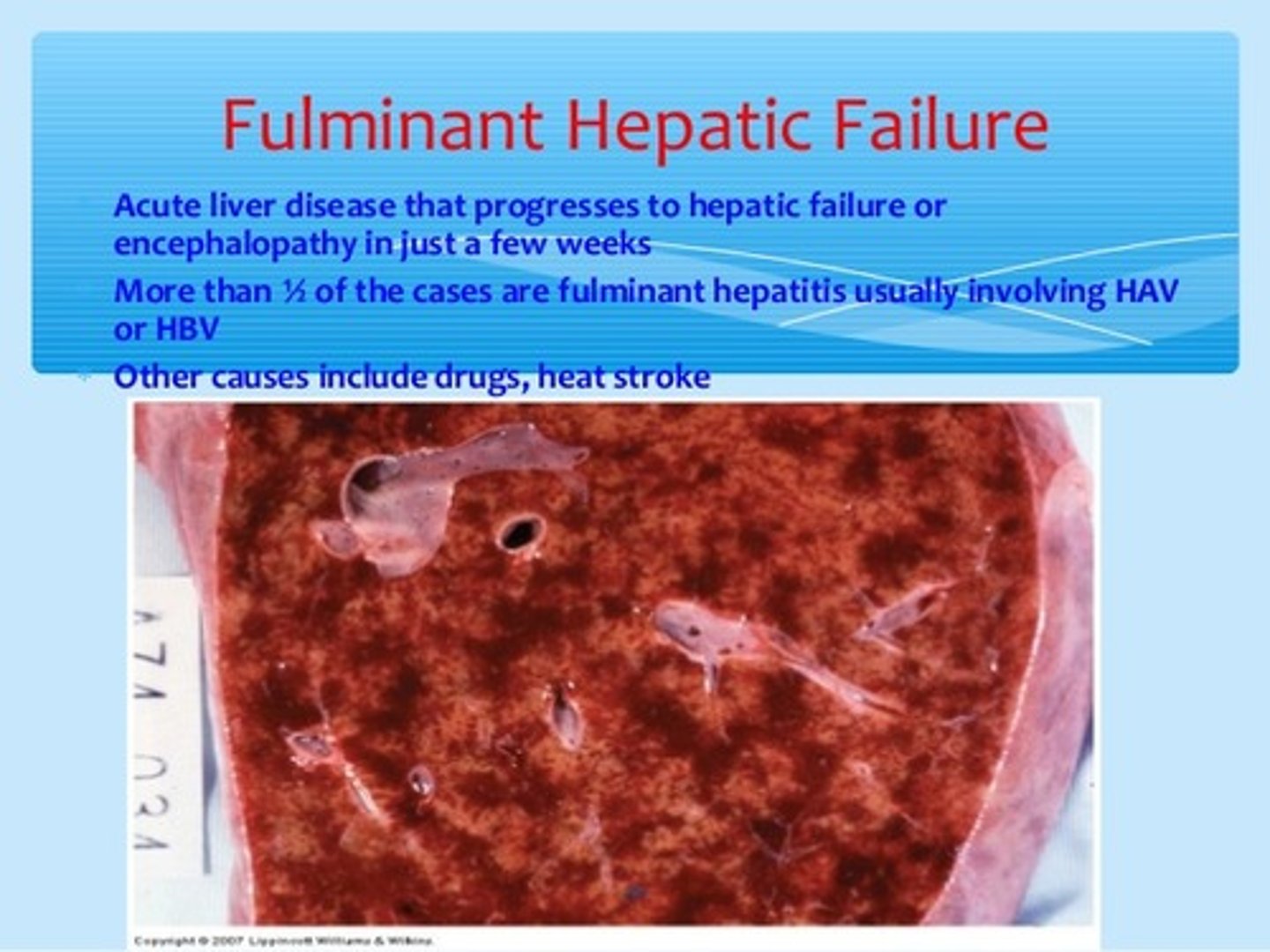 <p>initially infected cell has ruptured next to non-infected neighbor cell-> release of intracellular enzymes-> digest non-infected neighbor-> more necrosis/inflammation</p><p>(indirect type of damage)</p>