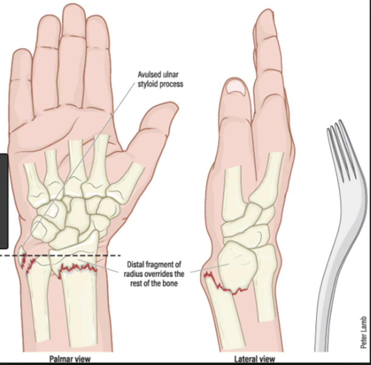 <p>FOOSH</p><p>"Dinner fork" deformity</p><p>Features of the injury:</p><p>(1) Transverse fracture of the radius</p><p>(2) 1 inch proximal to the radio-carpal joint</p><p>(3) Dorsal displacement and angulation</p>
