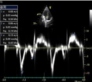 <p>how would you characterize this pts diastolic function?</p>