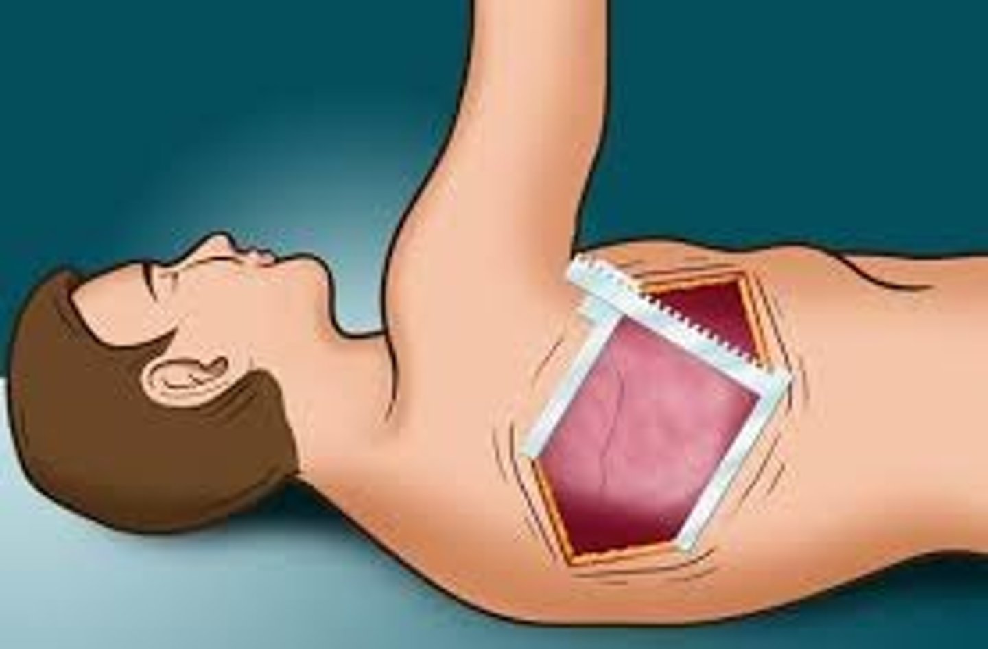 <p>incision into the chest cavity</p>