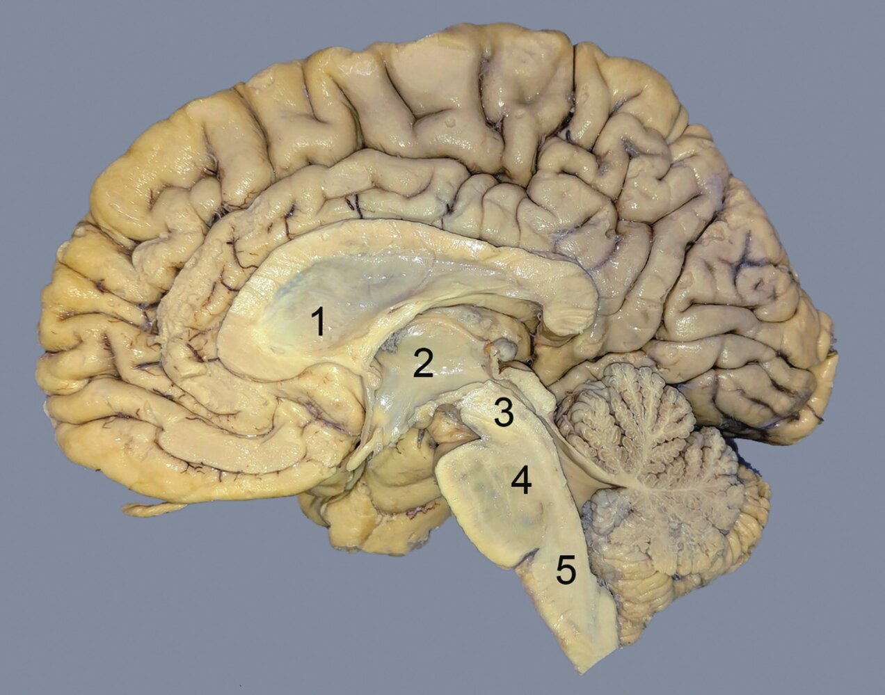 <p>64. Which number marks the metencephalon?</p><p>(The image shows a brain cut down the middle, viewed from the inside.)</p><p>A. 1</p><p>B. 2</p><p>C. 3</p><p>D. 4</p><p>E. 5</p>