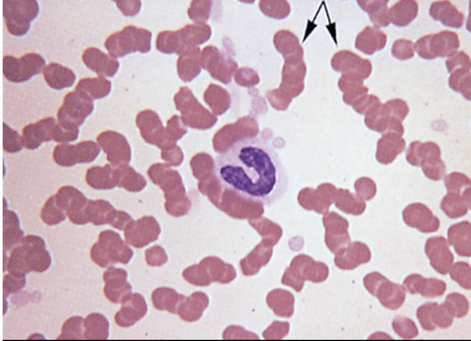 The red blood cell below are exhibiting 