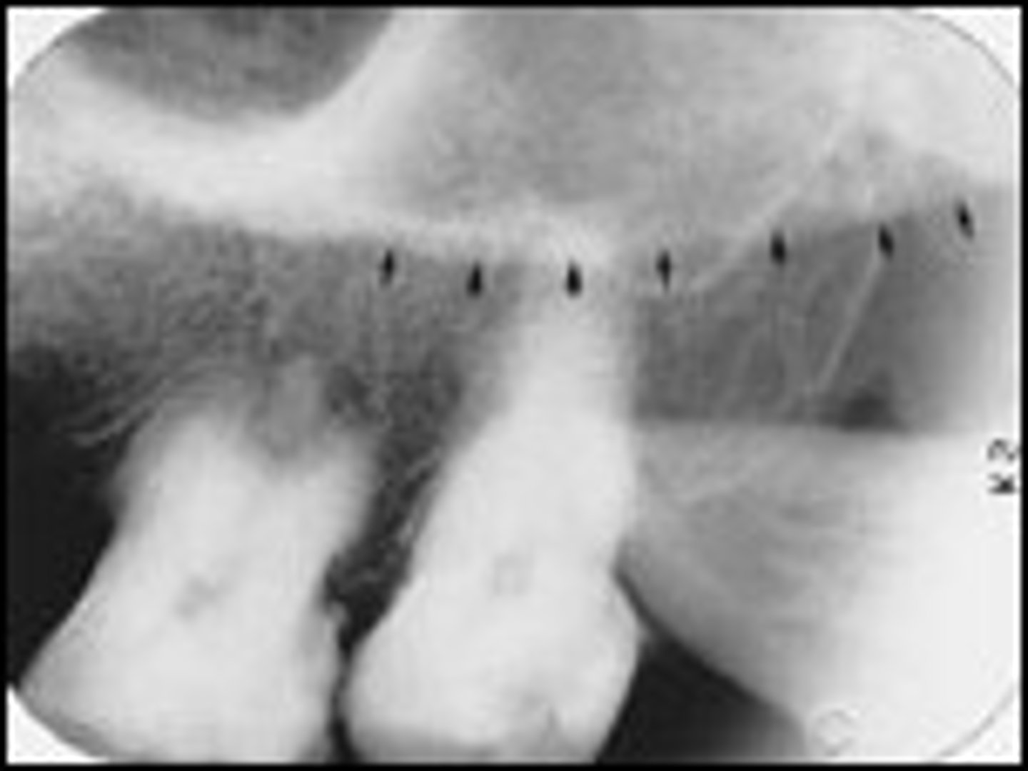 <p>portion of the cheek bone</p><p>radiopaque</p>