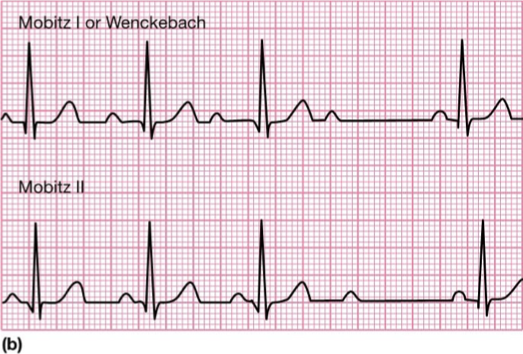 <p>What does this refer</p><ul><li><p>P waves are not all followed by QRS complex, temporary failure of AV conduction</p></li><li><p>Mobitz I shows progressive PR lengthening before nonconducted P wave</p></li></ul><p></p>