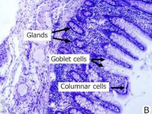 <p><span style="color: red"><strong><mark data-color="red" style="background-color: red; color: inherit"><u>Epithelium:</u></mark></strong></span></p><ul><li><p><strong><u>Type of glands:</u> </strong><span style="color: red"><strong>Straight tubular glands</strong></span></p></li><li><p><strong><u>Type of lining:</u> </strong><span style="color: red"><strong>Absorptive columnar cells</strong></span></p></li><li><p><strong><u>Type of cells:</u> </strong></p><ul><li><p><span style="color: red"><strong>Goblet cells </strong></span></p></li><li><p><span style="color: red"><strong>Stem cells </strong></span></p></li><li><p><span style="color: red"><strong>Lymphocytes</strong></span></p></li></ul></li></ul><p><span style="color: red"><strong><mark data-color="red" style="background-color: red; color: inherit"><u>Lamina propria:</u></mark></strong></span></p><ul><li><p><strong><u>Consist of:</u> </strong></p><ul><li><p><span style="color: red"><strong>Loose CT </strong></span></p></li><li><p><span style="color: red"><strong>Blood </strong></span>and <span style="color: red"><strong>lymphatic vessels </strong></span></p></li><li><p><span style="color: red"><strong>Collagen </strong></span></p></li><li><p><span style="color: red"><strong>Lymphocytes </strong></span></p></li><li><p><span style="color: red"><strong>Plasma cells</strong></span></p></li></ul></li></ul><p><span style="color: red"><strong><mark data-color="red" style="background-color: red; color: inherit"><u>Muscularis mucosae:</u></mark></strong></span></p><ul><li><p><strong><u>Location:</u> </strong><span style="color: red"><strong>Beneath base</strong></span><strong> </strong>of the <span style="color: red"><strong>crypts</strong></span><strong> </strong></p></li><li><p><strong><u>Function:</u> </strong><span style="color: red"><strong>Undergoes rhythmic contractions</strong></span></p></li></ul><p></p>