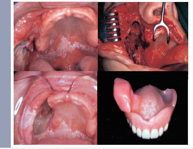 <p>Oronasale fistel (gat naar)<br>Oro-antrale fistel<br>Trismus</p><p>→ prothese kan makkelijk worden aangemaakt→ hermetische afsluiting zodat spreken en eten mogelijk is</p>