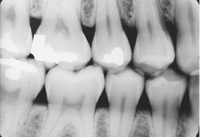 <ul><li><p><span style="font-family: Aptos, sans-serif">to examine the crowns and contacts of both the maxillary and mandibular teeth on a single film</span></p></li><li><p><span style="font-family: Aptos, sans-serif">used for interproximal examination, therefore no overlapping can occur</span></p></li><li><p><span style="font-family: Aptos, sans-serif">uses bite-wing receptor</span></p></li><li><p><span style="font-family: Aptos, sans-serif">uses bite-wing technique</span></p></li></ul><p></p>