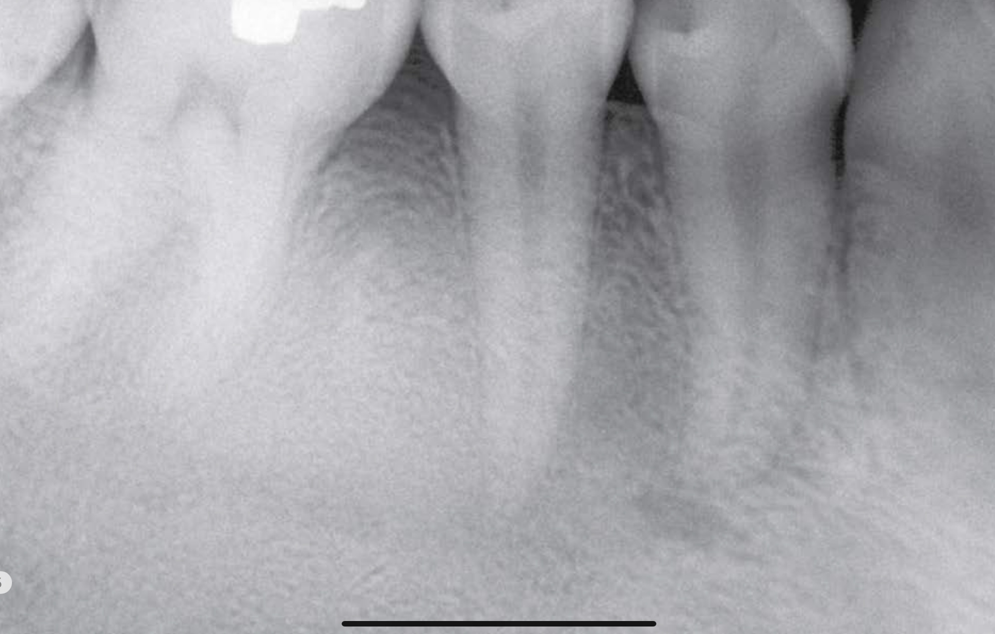 <p>Ground glass </p>