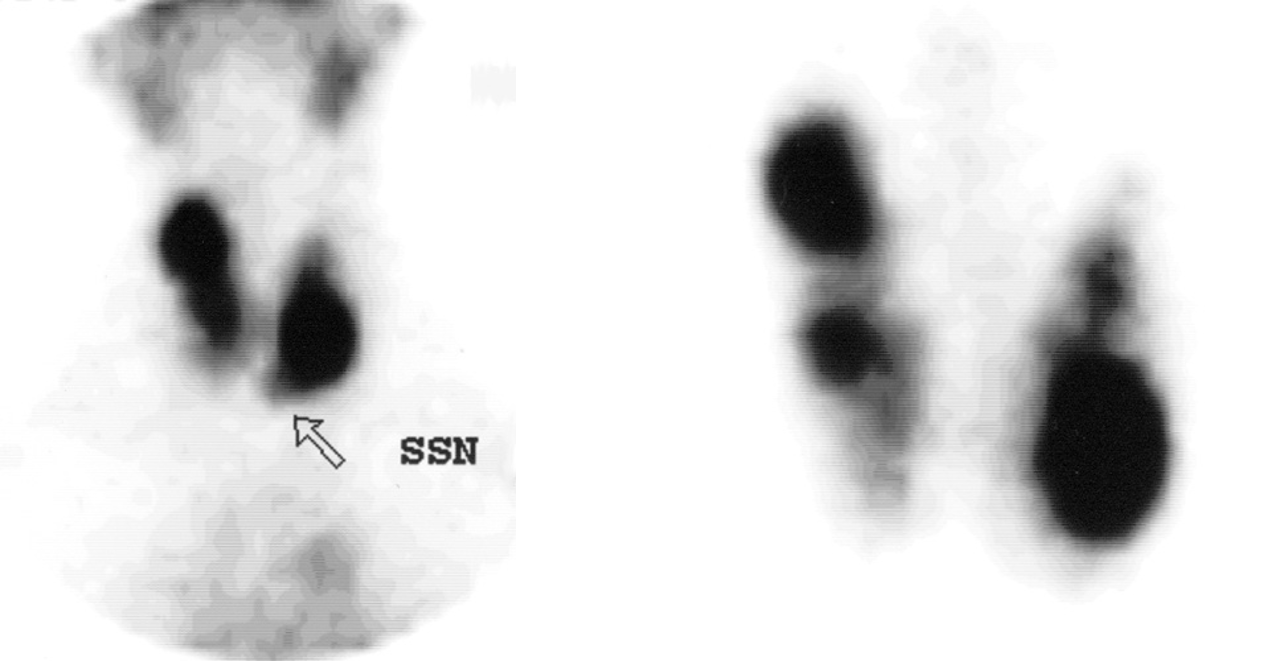 <p>Pt. is a 61 year-old female with suppressed (low) TSH, and a diffusely enlarged thyroid. What is your impression of this scan?</p>