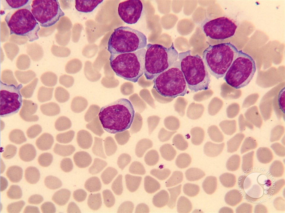 <p>size: 18-28 um</p><p>chromatin: condensing, some blocks </p><p>cytoplasm: deeply basophilic, but more abundant</p><p>N:C ratio: moderate, nucleus has shrunk </p>