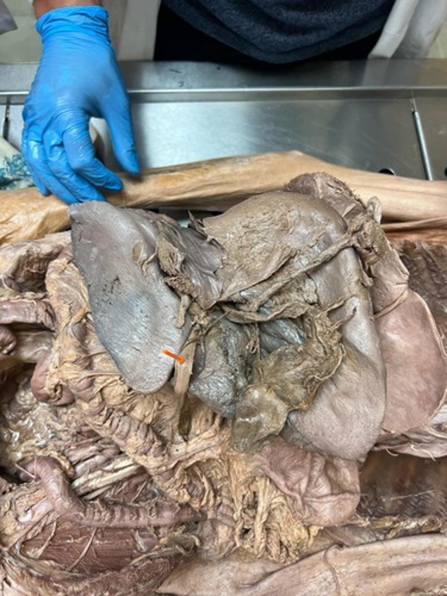<p>round ligament of liver</p>