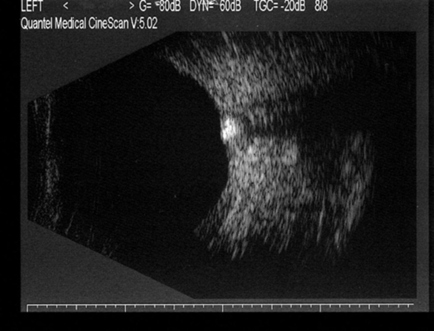 <p>hyper-reflective if calcified</p>