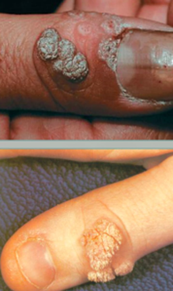 <p>Viral Skin Infections:</p><p>a<strong> common wart</strong></p><p>- hyperkeratotic, firm papules</p><p>- clefted surface with vegetations</p><p>- red/brown dots: thrombosed capillaries</p><p>-when on palms, it can disrupt fingerprints</p>