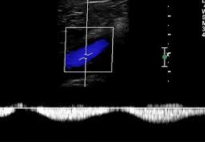 <p>Does this doppler waveform show a vessel that displays spontaneity or patency?</p>