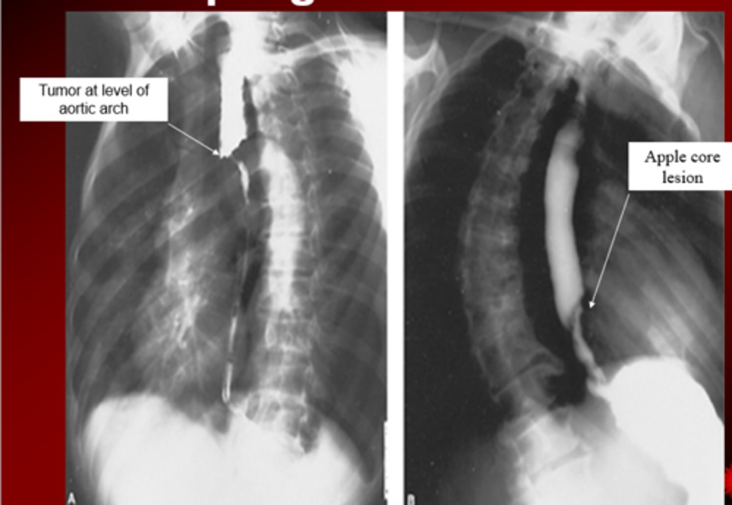 <p>adenocarcinoma</p>