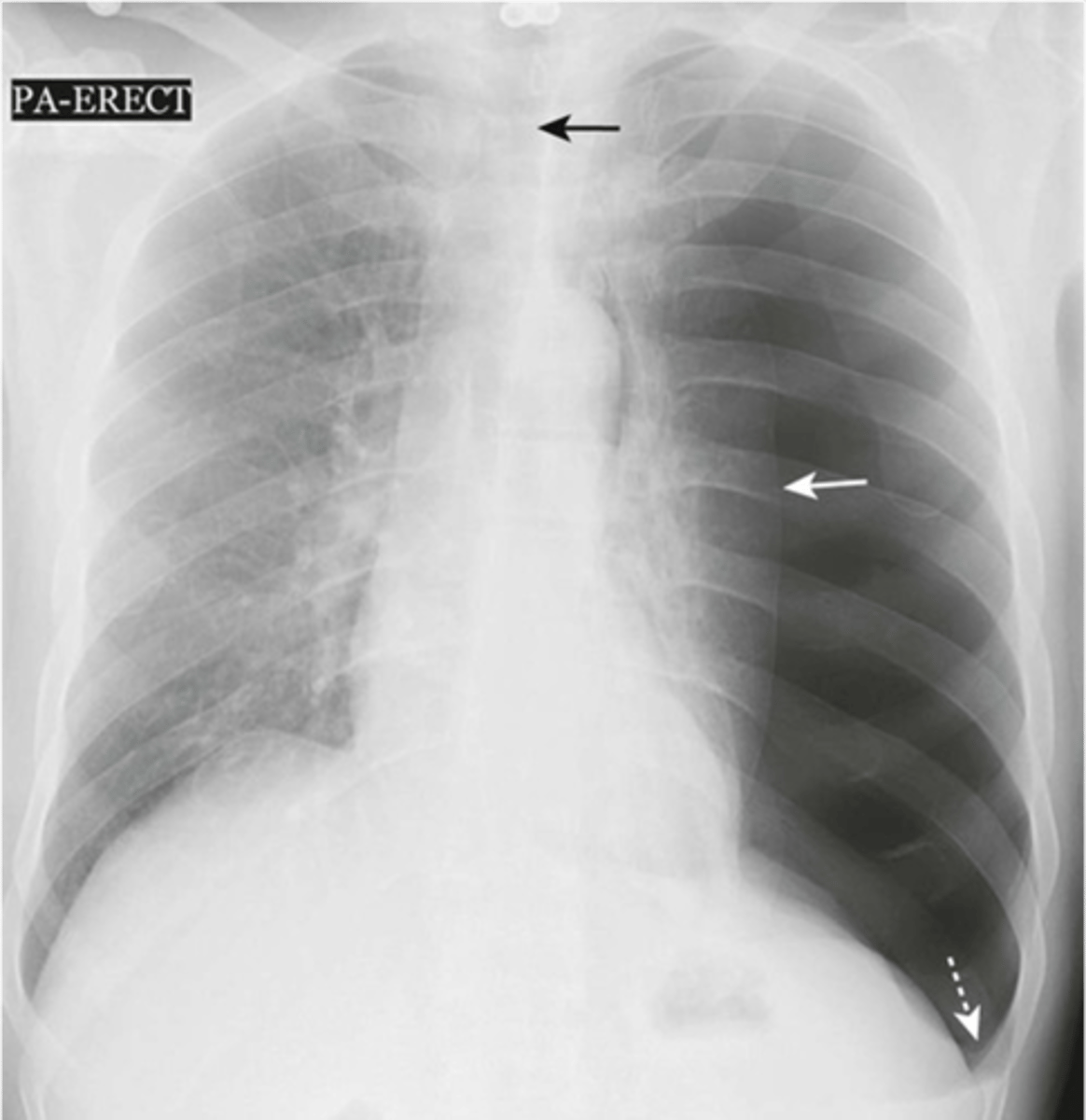 <p>-mediastinal and trachea shift</p><p>-almost total collapse of lung</p><p>-left diaphragm depressed</p>