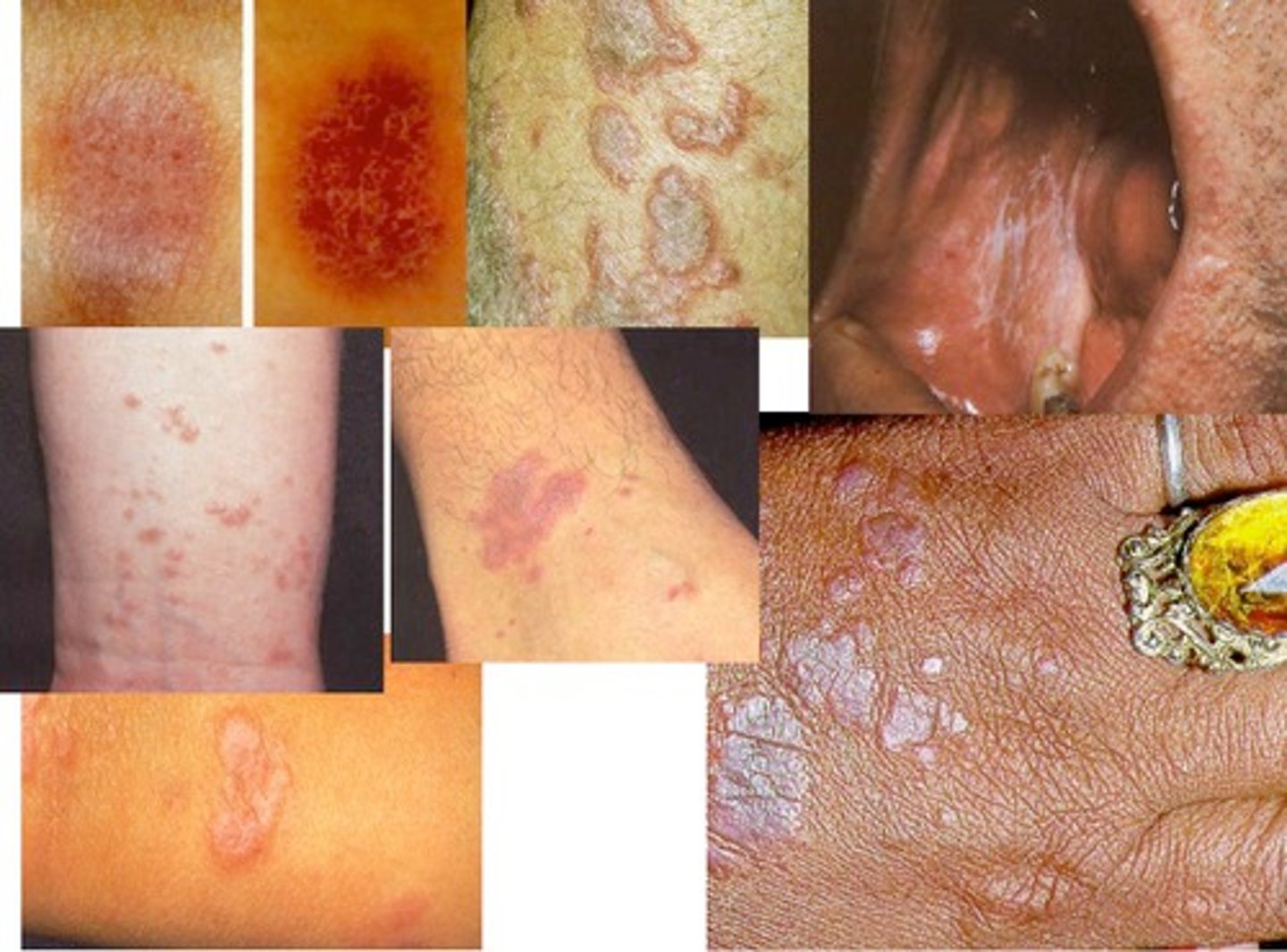 <p>Purple, Polygonal, Planar (flat-topped), Pruritic Papules, Plaques</p>