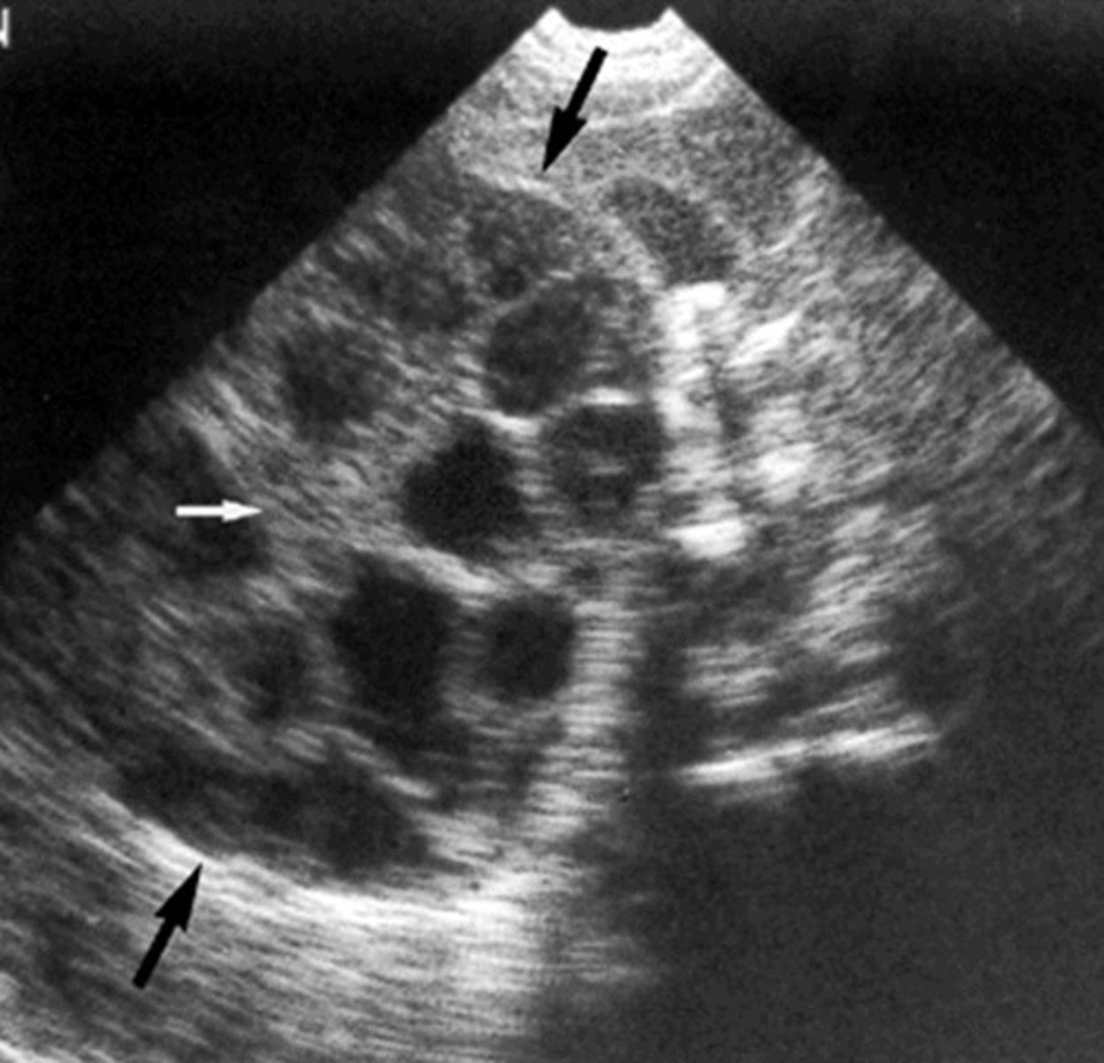 <p>Parasitic/hydatid cyst</p>
