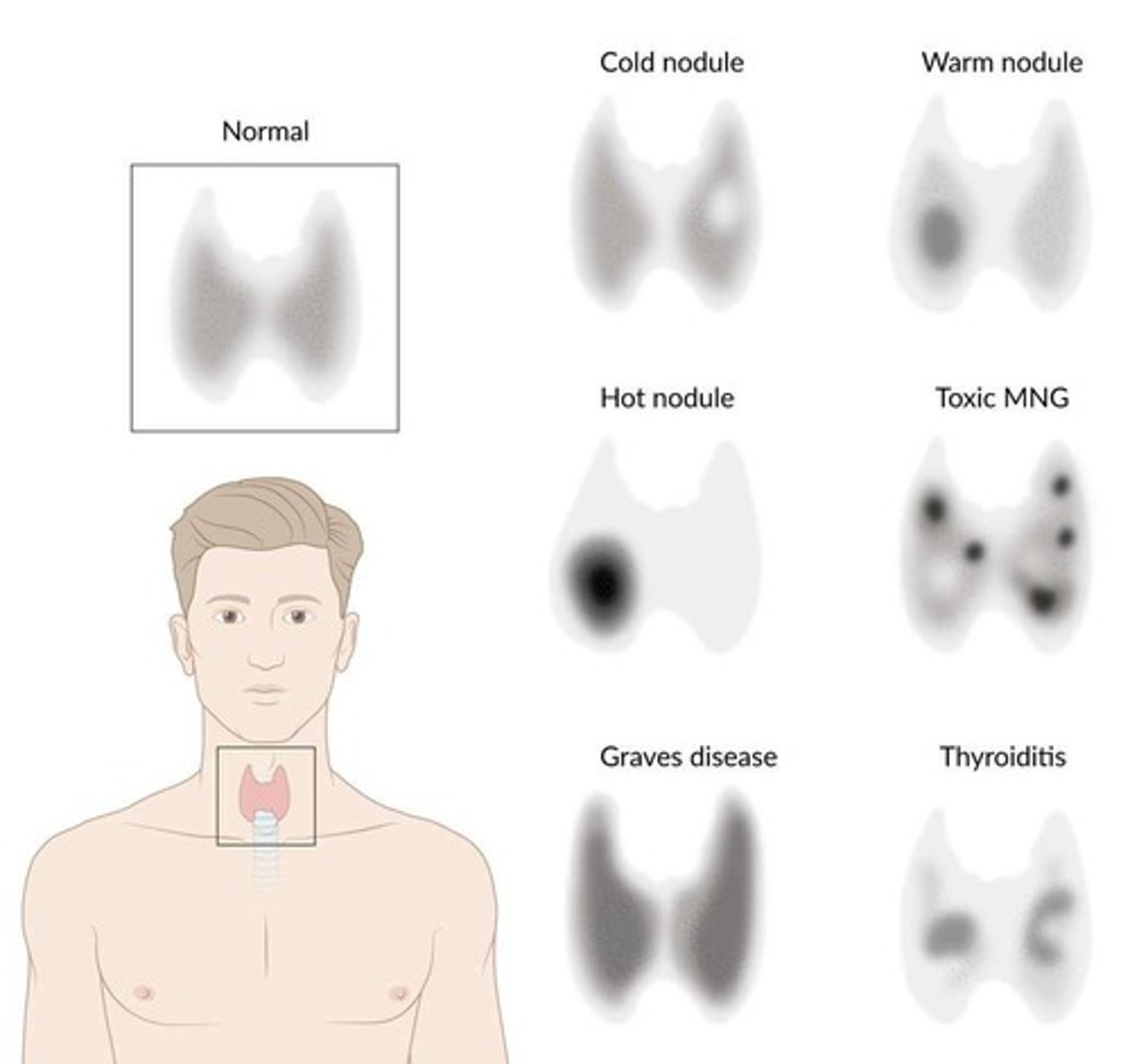 <p>To evaluate thyroid function and characterize nodules as 'hot' or 'cold'.</p>
