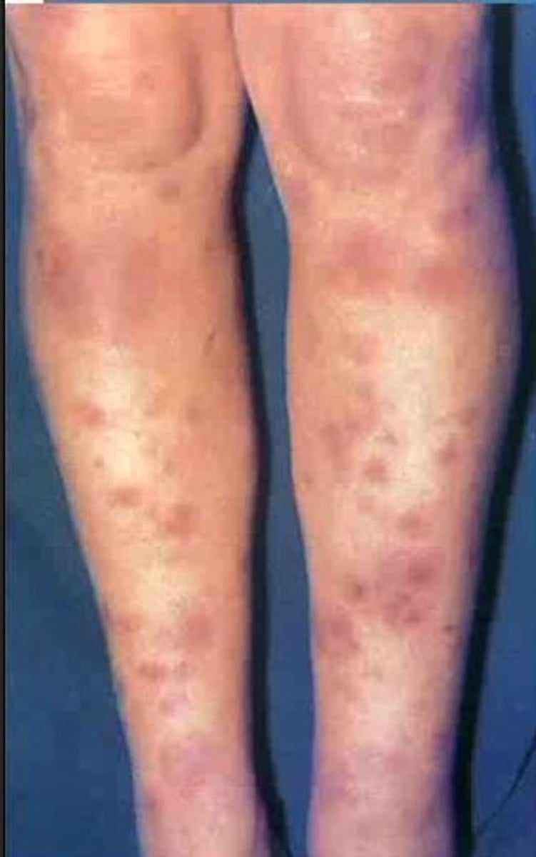 <p>Erythema nodosum</p><p>(Panniculitis occurs when there is inflammation of subcutaneous fat (the layer of fat lying underneath the skin). The inflammation causes rounded, tender red bumps (nodules) to form just below the skin surface.) </p>