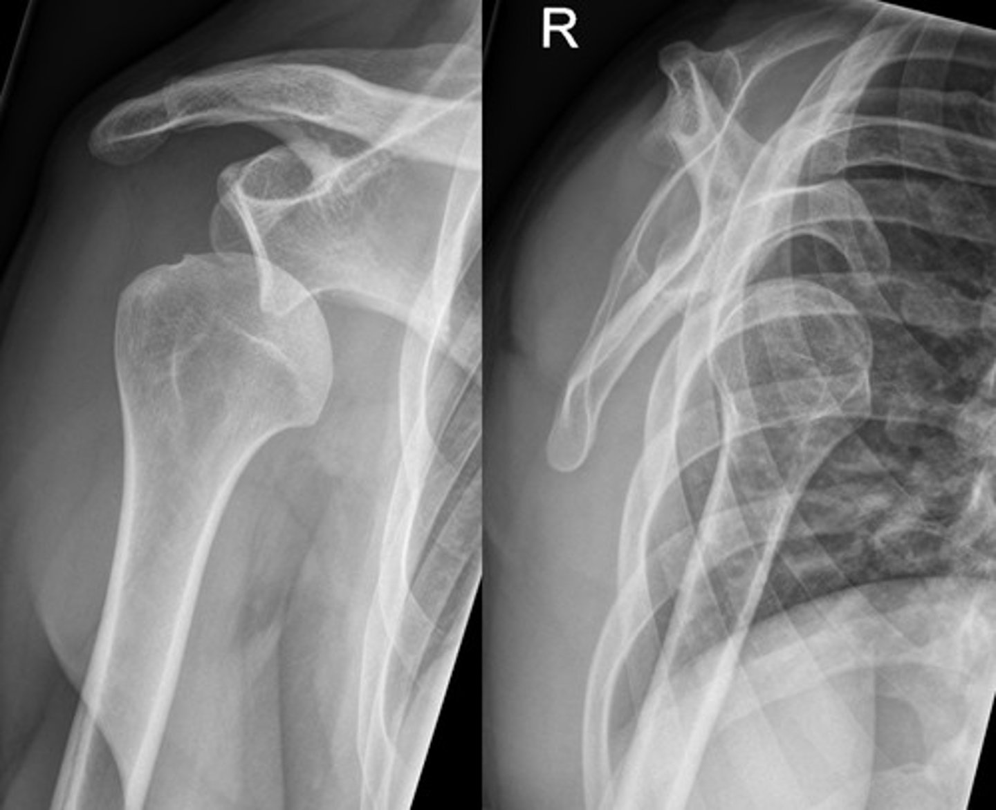 <p>Displacement of the humeral head from the glenoid fossa </p><p>ANTERIOR - MOST COMMON (95%) - arm abducted and externally rotated</p><p>Posterior - often due to seizures, electrocution, or trauma </p><p>inferior - rare</p>