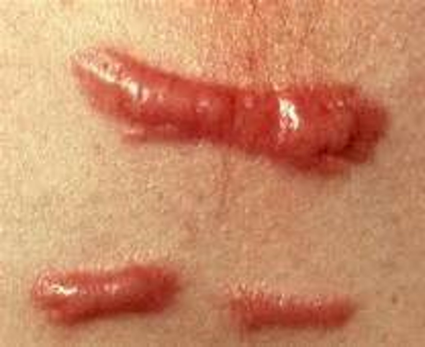 <p>excessive scar tissue grows outside of the original margins of the wound. Hypertrophy but spread out.</p>