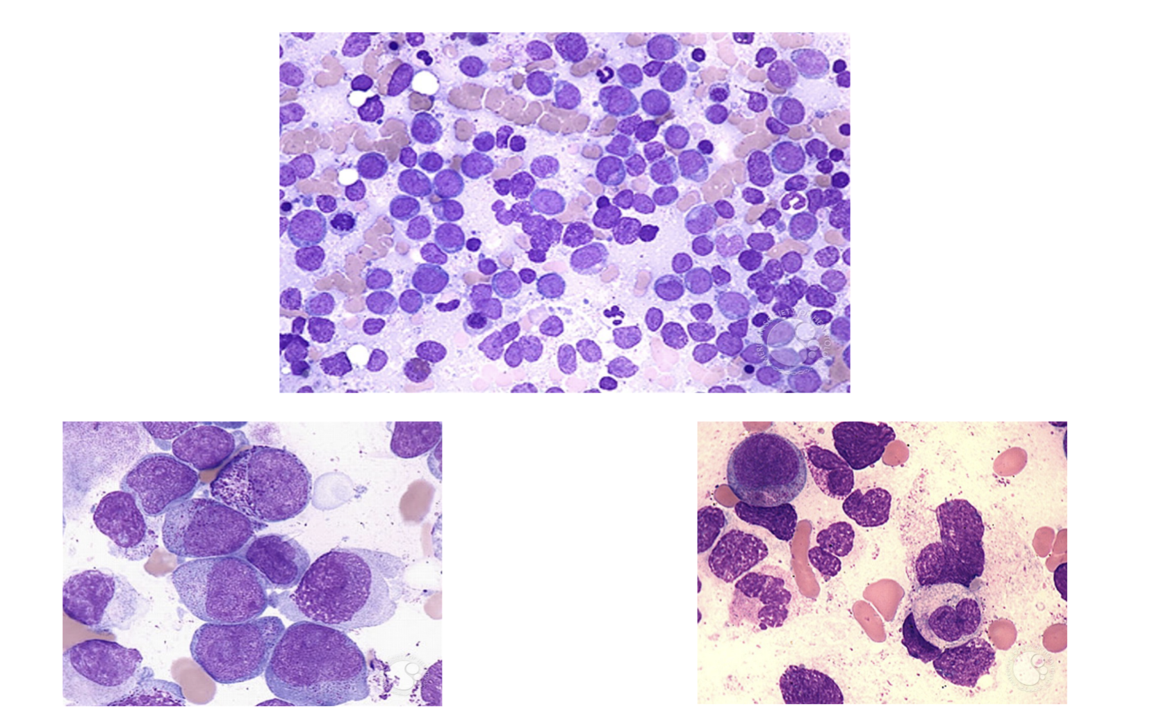 <ul><li><p>Blasts do not mature</p></li><li><p> Leukemic cells are arrested at an immature stage</p><ul><li><p>Leukemia Hiatus: presence of blast cells and mature cells without an orderly morphologic progression between the 2</p></li></ul></li><li><p> Lack of normal differentiation antigens and are unable to respond to normal regulatory feedback control</p></li></ul><p></p>