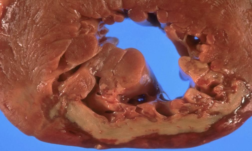 <p>Myocardial Infarction</p>