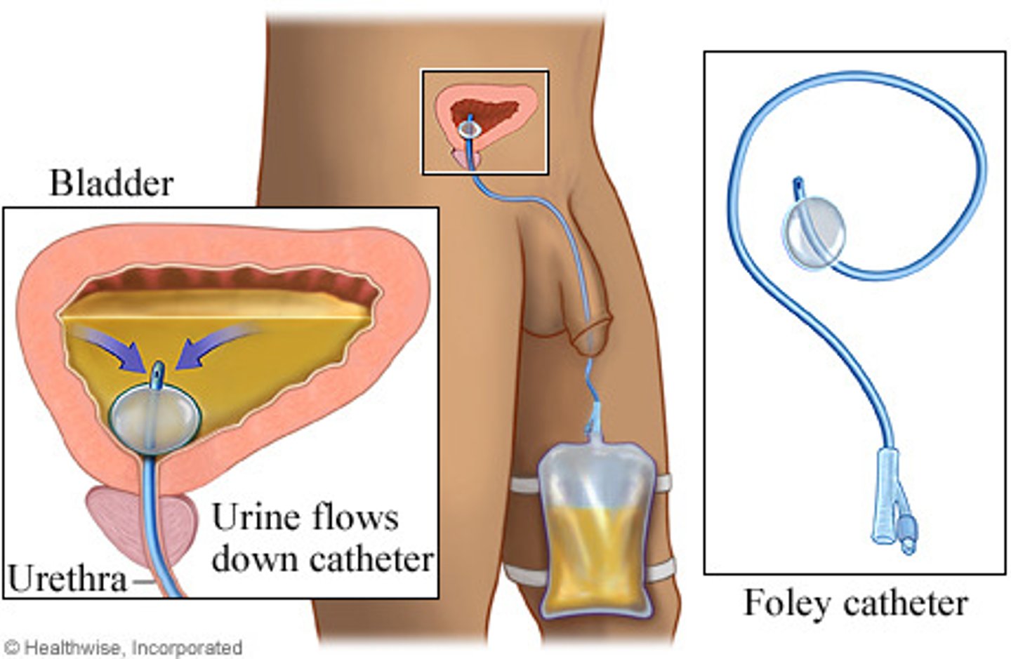 <p>peformed by inserting a tube along the urethra and into the bladder</p>