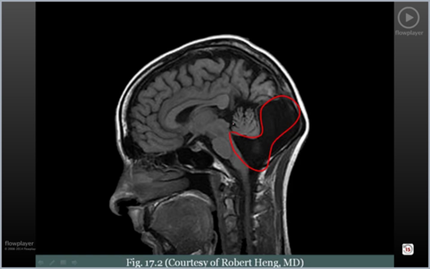 <p>absence or dysplasia of cerebellar vermis, splayedcerebellum, high-riding 4th ventricle</p>
