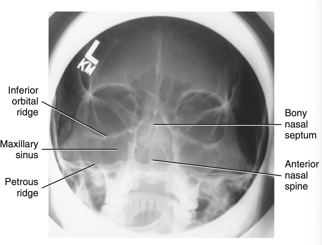 <p>Special: What is <u>best demonstrated</u> for <strong>Modified Parietocanthial projection: Modified waters method </strong>for <strong>facial bone</strong>?</p>