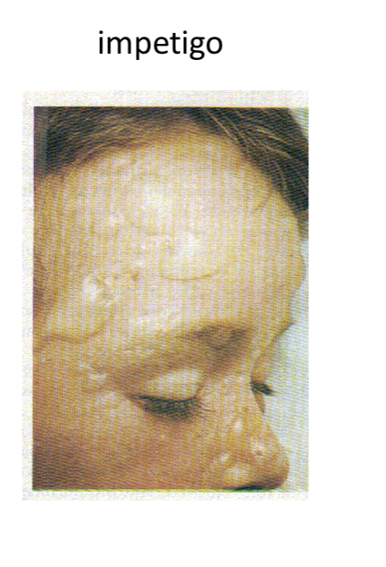 <p>Impetigo</p>
